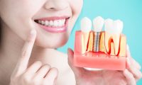 Địa Chỉ Cấy Ghép Răng Implant Uy Tín An Toàn Chất Lượng?