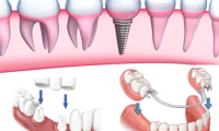 Nên Làm Răng Gỉa Bằng Cấy Ghép Implant Hay Cầu Răng Sứ Là Tốt Nhất?
